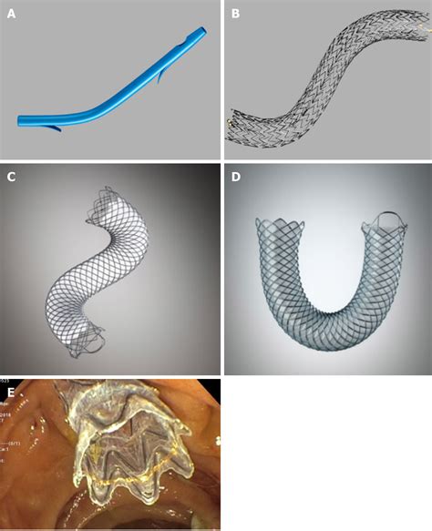 metallic stents reviews